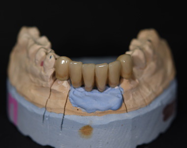 Barousis Dental Lab Μεταλλοκεραμικές Αποκαταστάσεις