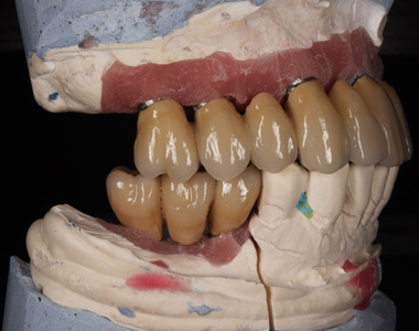 Barousis Dental Lab Συγκολυόμενες Αποκαταστάσεις