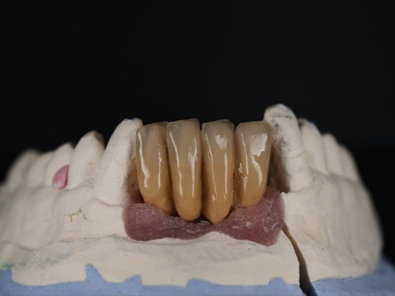 Επιεμφυτευματική-Κοχλιούμενη