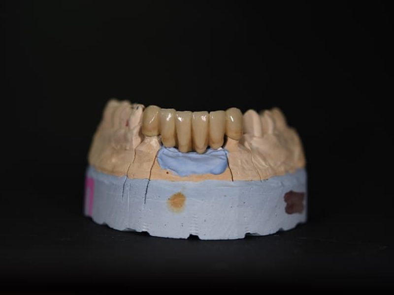 Μεταλλοκεραμική-Γέφυρα