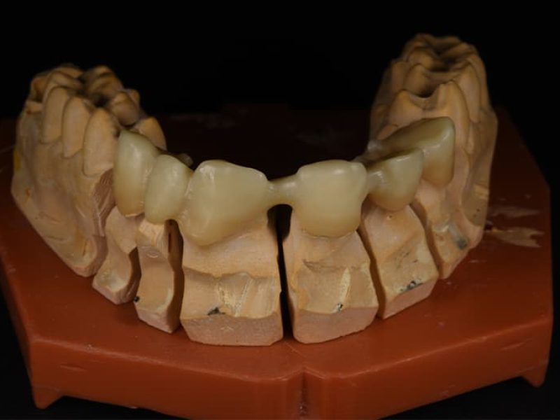 Ολοκεραμικό_Ζιρκόνιο